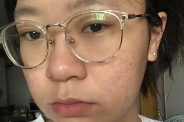 紅藍(lán)光祛痘的作用及副作用 紅藍(lán)光祛痘到底有沒(méi)有效果 紅藍(lán)光祛痘的作用及副作用 紅藍(lán)光祛痘到底有沒(méi)有效果