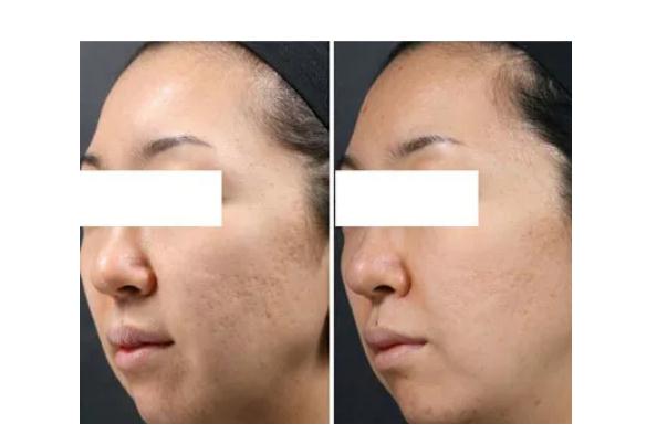 紅藍(lán)光祛痘印多久見效 紅藍(lán)光祛痘要做多少次 紅藍(lán)光祛痘印多久見效 紅藍(lán)光祛痘要做多少次