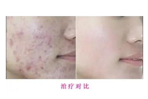 紅藍(lán)光祛痘印多久見效 紅藍(lán)光祛痘要做多少次 紅藍(lán)光祛痘印多久見效 紅藍(lán)光祛痘要做多少次