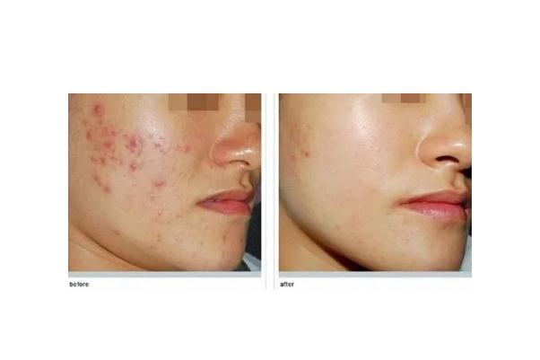 激光祛痘會(huì)留疤嗎 激光祛痘會(huì)再次復(fù)發(fā)嗎