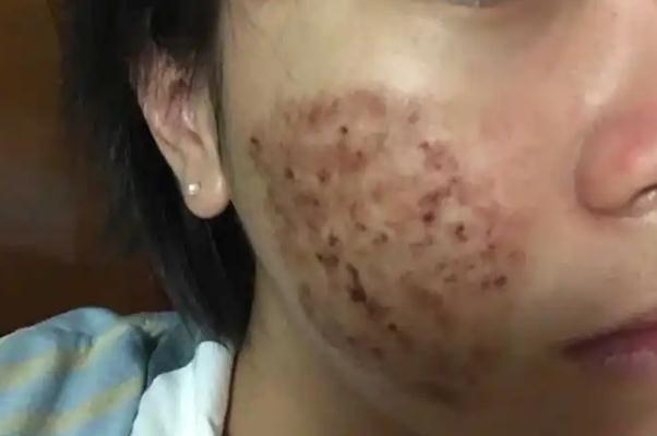 激光祛痘會(huì)留下痘坑嗎 激光祛痘會(huì)不會(huì)對(duì)皮膚有影響 激光祛痘會(huì)留下痘坑嗎 激光祛痘會(huì)不會(huì)對(duì)皮膚有影響