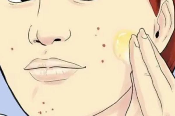 激光祛痘會(huì)留下痘坑嗎 激光祛痘會(huì)不會(huì)對(duì)皮膚有影響 激光祛痘會(huì)留下痘坑嗎 激光祛痘會(huì)不會(huì)對(duì)皮膚有影響