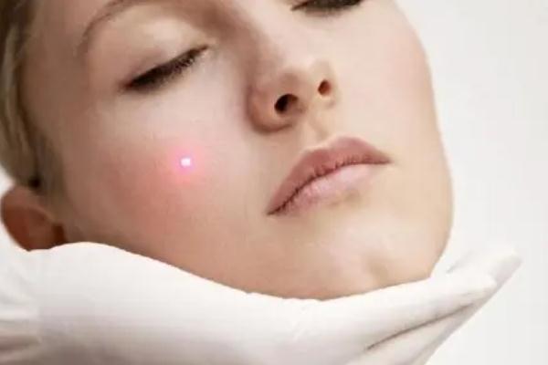 激光祛痘會留疤嗎 激光祛痘會再次復(fù)發(fā)嗎 激光祛痘會留疤嗎 激光祛痘會再次復(fù)發(fā)嗎