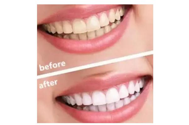 冷光美白牙齒要做幾次 牙齒冷光美白的機理 冷光美白牙齒要做幾次 牙齒冷光美白的機理