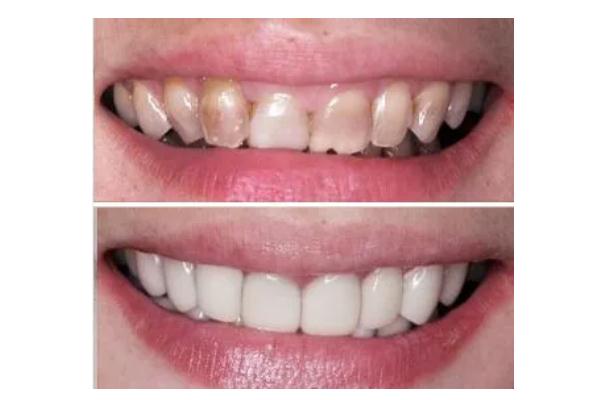 冷光美白牙齒有危害嗎 冷光美白牙齒有年齡限制嗎 冷光美白牙齒有危害嗎 冷光美白牙齒有年齡限制嗎