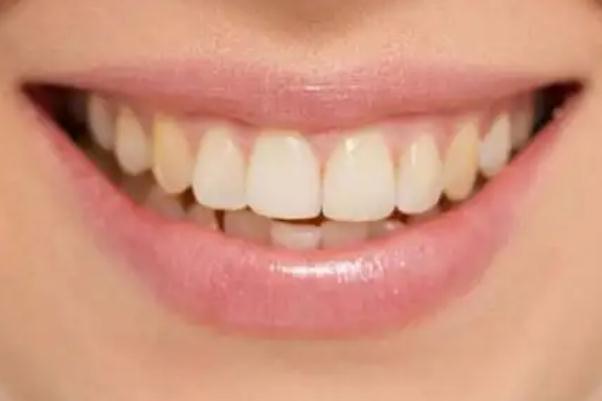 冷光美白牙齒可以抽煙嗎 冷光美白牙齒可以喝酒嗎 冷光美白牙齒可以抽煙嗎 冷光美白牙齒可以喝酒嗎