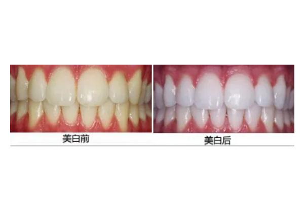 冷光美白牙齒是立馬見(jiàn)效嗎 冷光美白牙齒是紫外線照射嗎 冷光美白牙齒是立馬見(jiàn)效嗎 冷光美白牙齒是紫外線照射嗎