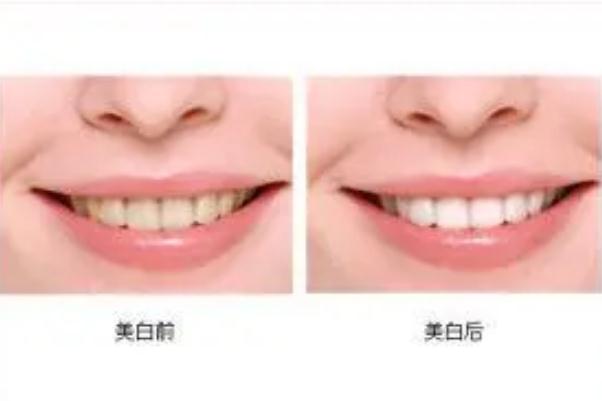 冷光美白牙齒后悔了 冷光美白牙齒的副作用 冷光美白牙齒后悔了 冷光美白牙齒的副作用