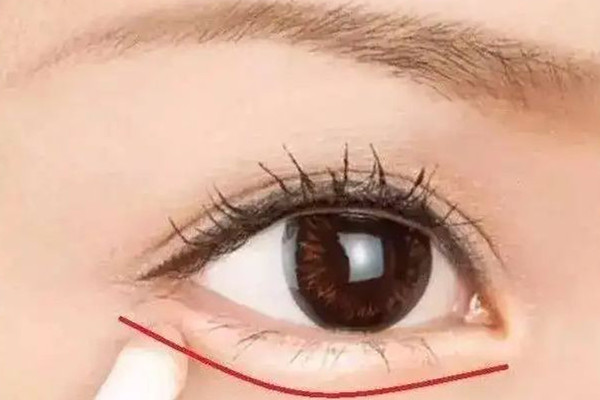 淚溝填充失敗怎么修復 淚溝填充后多久能看到效果 淚溝填充失敗怎么修復 淚溝填充后多久能看到效果