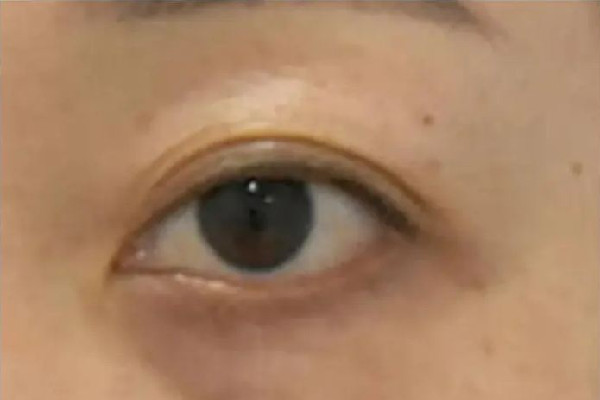 填淚溝是膠原蛋白好還是玻尿酸好 填淚溝需要注意什么 填淚溝是膠原蛋白好還是玻尿酸好 填淚溝需要注意什么