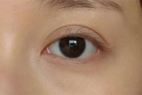 淚溝填充后黑眼圈重怎么回事 淚溝填充后怎么護(hù)理 淚溝填充后黑眼圈重怎么回事 淚溝填充后怎么護(hù)理