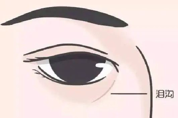 填淚溝玻尿酸用中分子還是小分子 填淚溝需要幾支玻尿酸 填淚溝玻尿酸用中分子還是小分子 填淚溝需要幾支玻尿酸