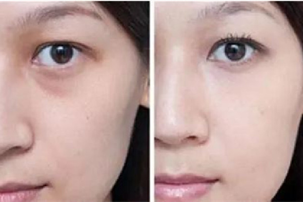 淚溝填充失敗怎么修復 淚溝填充后多久能看到效果 淚溝填充失敗怎么修復 淚溝填充后多久能看到效果