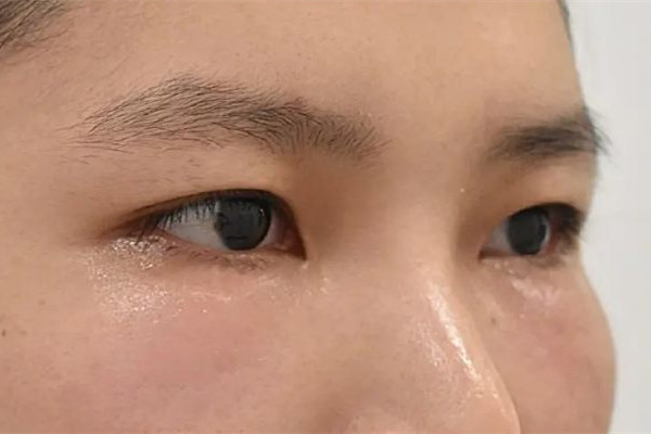 填淚溝用什么方法最好 填淚溝有幾種方法 填淚溝用什么方法最好 填淚溝有幾種方法