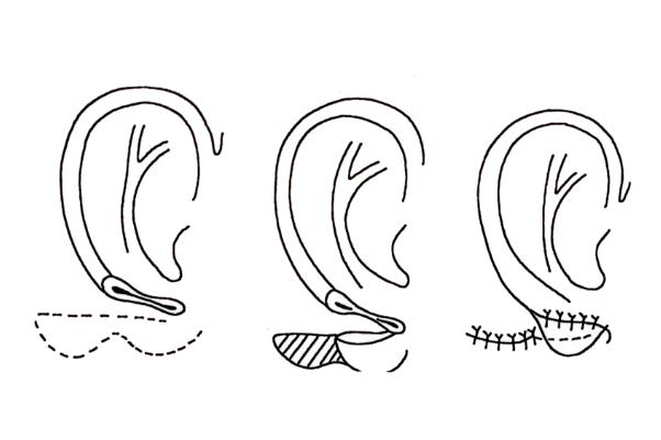 豐耳垂的危害 豐耳垂是什么意思 豐耳垂的危害 豐耳垂是什么意思
