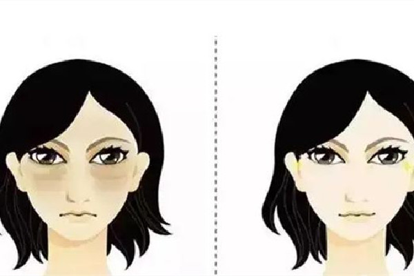 填淚溝填成眼袋怎么辦 填淚溝會不會造成失明 填淚溝填成眼袋怎么辦 填淚溝會不會造成失明