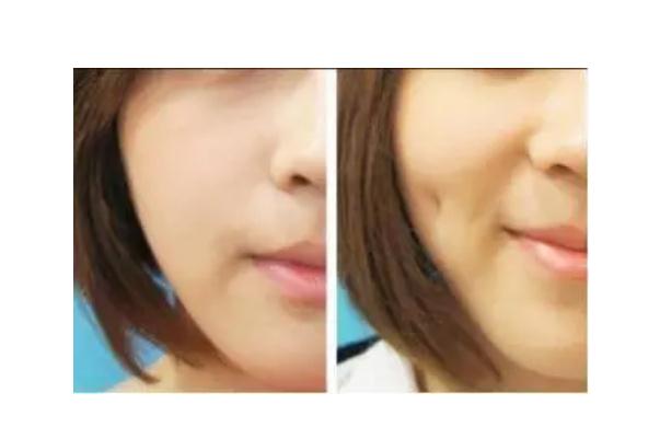 人造酒窩會(huì)消失嗎 酒窩成形術(shù)適合臉頰消瘦的人嗎 人造酒窩會(huì)消失嗎 酒窩成形術(shù)適合臉頰消瘦的人嗎