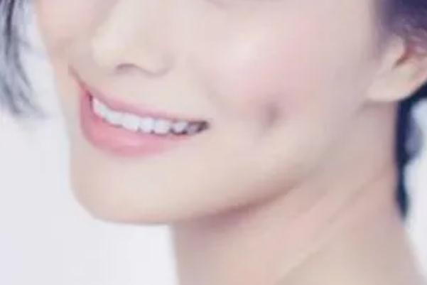 人造酒窩會(huì)消失嗎 酒窩成形術(shù)適合臉頰消瘦的人嗎 人造酒窩會(huì)消失嗎 酒窩成形術(shù)適合臉頰消瘦的人嗎