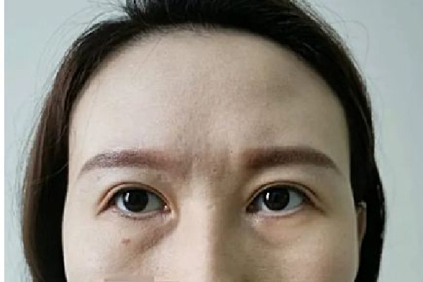 填淚溝用什么方法最好 填淚溝有幾種方法 填淚溝用什么方法最好 填淚溝有幾種方法