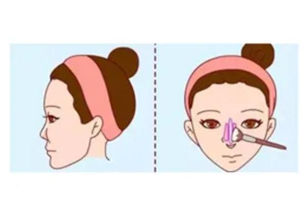 朝天鼻矯正有后遺癥么 朝天鼻該如何矯正過(guò)來(lái) 朝天鼻矯正有后遺癥么 朝天鼻該如何矯正過(guò)來(lái)