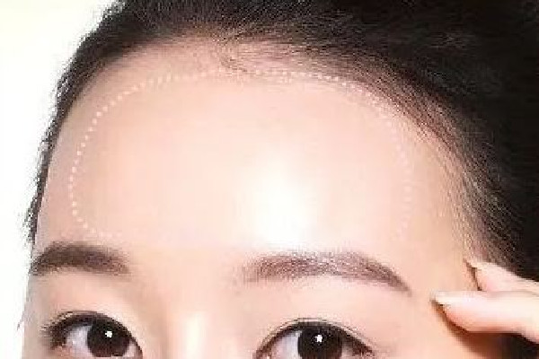 額頭填充是局麻還是全麻 額頭填充怎么做的 額頭填充是局麻還是全麻 額頭填充怎么做的