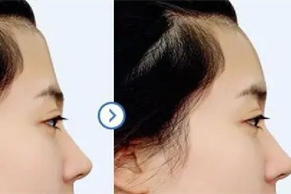 填充額頭是不是顯的臉小點 額頭填充適合什么臉型 填充額頭是不是顯的臉小點 額頭填充適合什么臉型