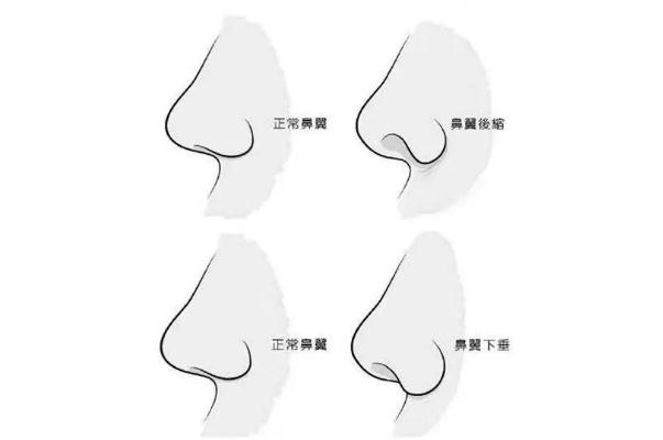 朝天鼻矯正一般多少錢 朝天鼻矯正風(fēng)險(xiǎn)大嗎 朝天鼻矯正一般多少錢 朝天鼻矯正風(fēng)險(xiǎn)大嗎