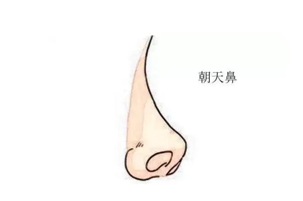 朝天鼻矯正一般多少錢 朝天鼻矯正風(fēng)險(xiǎn)大嗎 朝天鼻矯正一般多少錢 朝天鼻矯正風(fēng)險(xiǎn)大嗎