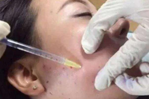 溶脂針的效果和副作用 溶脂針價格多少錢一針 溶脂針的效果和副作用 溶脂針價格多少錢一針