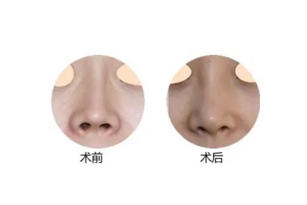 朝天鼻矯正算整容嗎 朝天鼻可以整容嗎 朝天鼻矯正算整容嗎 朝天鼻可以整容嗎