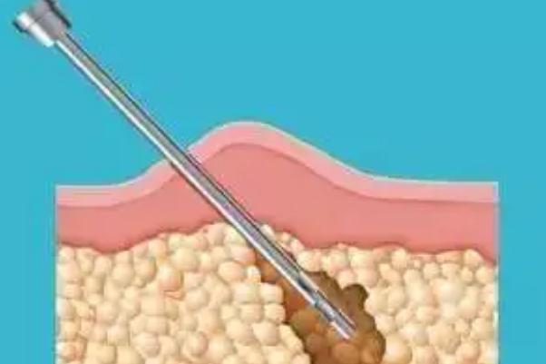 溶脂針的效果和副作用 溶脂針價格多少錢一針 溶脂針的效果和副作用 溶脂針價格多少錢一針