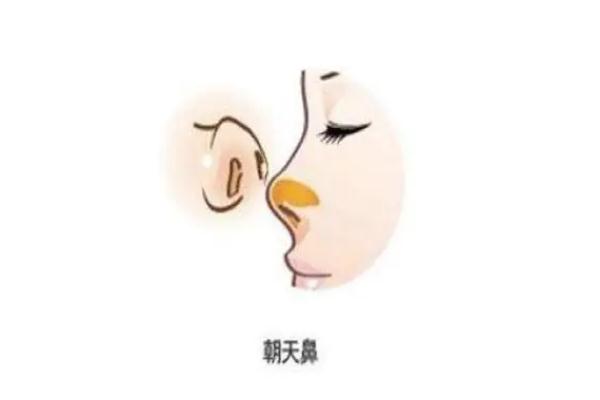 朝天鼻矯正一般多少錢 朝天鼻矯正風(fēng)險(xiǎn)大嗎 朝天鼻矯正一般多少錢 朝天鼻矯正風(fēng)險(xiǎn)大嗎