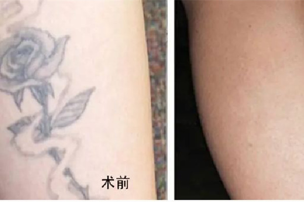 洗紋身要隔多久洗第二次 洗紋身按什么收費(fèi)的 洗紋身要隔多久洗第二次 洗紋身按什么收費(fèi)的