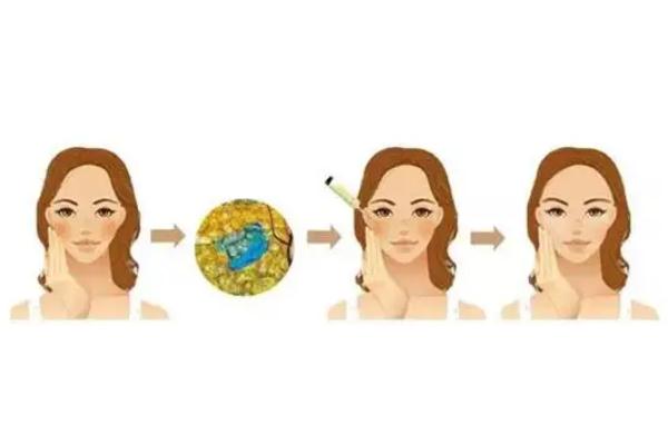 蘋果肌復(fù)位的注意事項(xiàng) 蘋果肌復(fù)位后要戴面罩嗎 蘋果肌復(fù)位的注意事項(xiàng) 蘋果肌復(fù)位后要戴面罩嗎