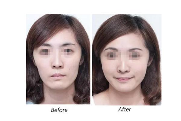 蘋果肌復位術多少錢 蘋果肌復位最好的辦法 蘋果肌復位術多少錢 蘋果肌復位最好的辦法