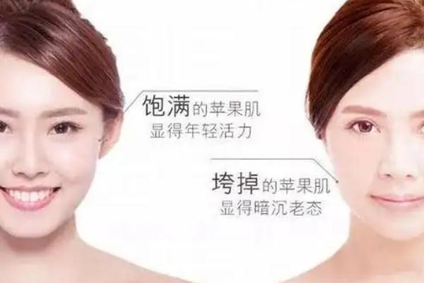 蘋(píng)果肌復(fù)位術(shù)怎么做 蘋(píng)果肌復(fù)位術(shù)可以保持多久 蘋(píng)果肌復(fù)位術(shù)怎么做 蘋(píng)果肌復(fù)位術(shù)可以保持多久