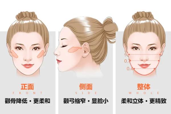 顴骨內(nèi)推手術(shù)多少錢啊 顴骨內(nèi)推后遺癥 顴骨內(nèi)推手術(shù)多少錢啊 顴骨內(nèi)推后遺癥