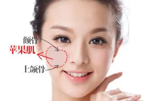 蘋(píng)果肌復(fù)位術(shù)怎么做 蘋(píng)果肌復(fù)位術(shù)可以保持多久 蘋(píng)果肌復(fù)位術(shù)怎么做 蘋(píng)果肌復(fù)位術(shù)可以保持多久