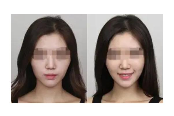 蘋果肌復位術多少錢 蘋果肌復位最好的辦法 蘋果肌復位術多少錢 蘋果肌復位最好的辦法