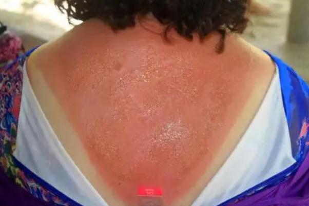 皮膚曬傷發(fā)紅怎么修復 皮膚曬傷怎么處理最好 皮膚曬傷發(fā)紅怎么修復 皮膚曬傷怎么處理最好