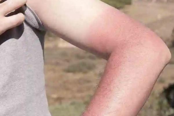 皮膚曬傷有灼燒感 皮膚曬傷有什么辦法 皮膚曬傷有灼燒感 皮膚曬傷有什么辦法