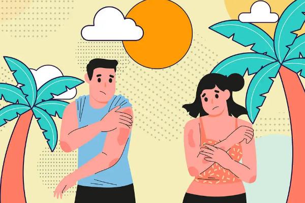 皮膚曬傷后留下黑色素該怎么去除 皮膚曬傷發(fā)紅擦什么藥 皮膚曬傷后留下黑色素該怎么去除 皮膚曬傷發(fā)紅擦什么藥