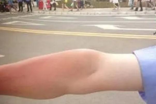 皮膚曬傷發(fā)紅怎么修復 皮膚曬傷怎么處理最好 皮膚曬傷發(fā)紅怎么修復 皮膚曬傷怎么處理最好