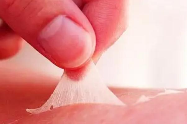 皮膚曬傷要注意什么 皮膚曬傷要去醫(yī)院?jiǎn)? alt=