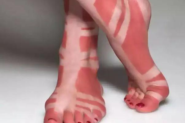 皮膚曬傷的急救方法 皮膚曬傷是怎么回事 皮膚曬傷的急救方法 皮膚曬傷是怎么回事