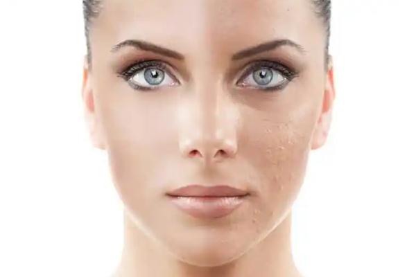 皮膚暗黃會造成什么影響 皮膚暗黃會自然恢復(fù)嗎 皮膚暗黃會造成什么影響 皮膚暗黃會自然恢復(fù)嗎