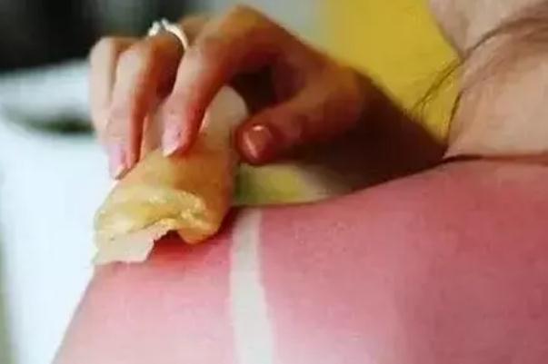 皮膚曬傷后留下黑色素該怎么去除 皮膚曬傷發(fā)紅擦什么藥 皮膚曬傷后留下黑色素該怎么去除 皮膚曬傷發(fā)紅擦什么藥