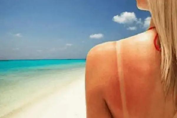 皮膚曬傷后留下黑色素該怎么去除 皮膚曬傷發(fā)紅擦什么藥 皮膚曬傷后留下黑色素該怎么去除 皮膚曬傷發(fā)紅擦什么藥