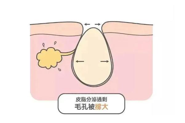 皮膚出油的表現(xiàn) 皮膚出油的好處 皮膚出油的表現(xiàn) 皮膚出油的好處