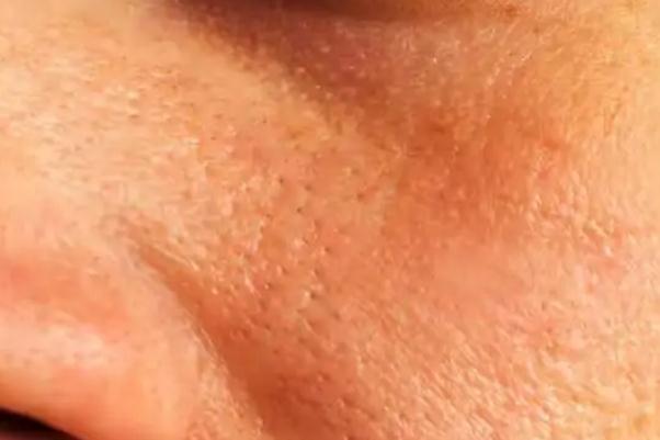 皮膚出油是怎么回事 皮膚出油要補(bǔ)水還是控油 皮膚出油是怎么回事 皮膚出油要補(bǔ)水還是控油